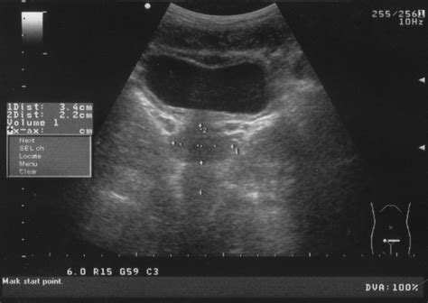 Ultrasound of the Urinary Tract .